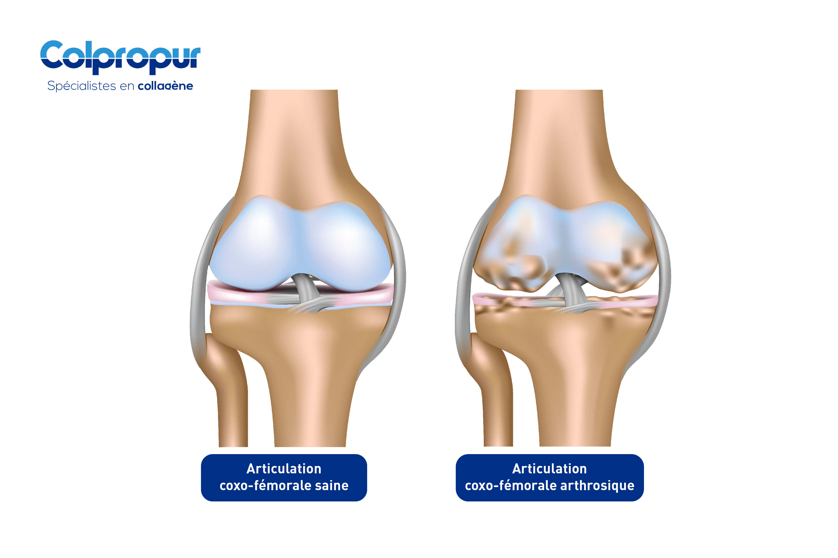 Comment vous protéger contre l'arthrose du genou ? - Colpropur