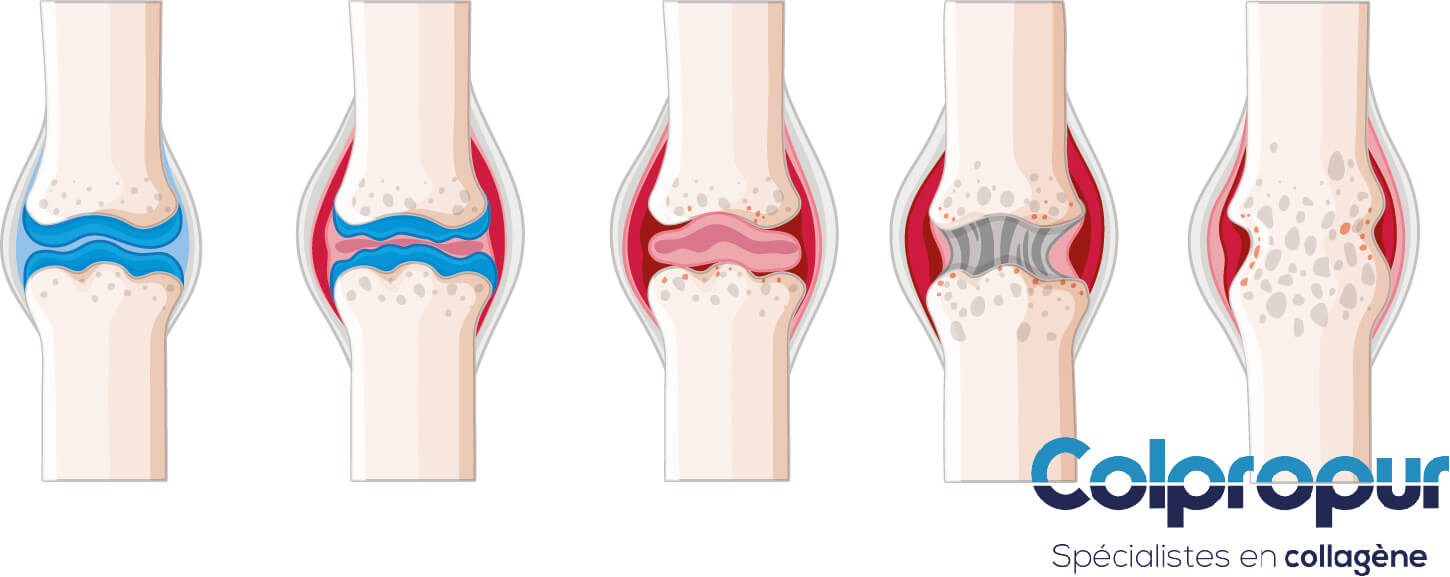 Comment vous protéger contre l'arthrose du genou ? - Colpropur